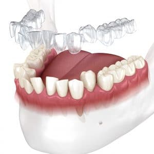 cleveland invisalign