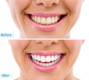 cleveland teeth whitening