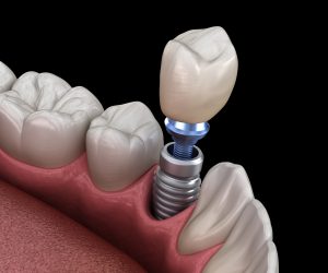 cleveland dental implants