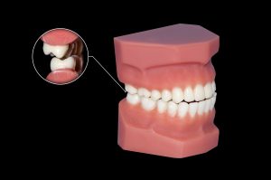 cleveland bruxism treatment