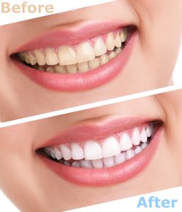 cleveland teeth whitening 