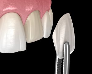 cleveland dental veneers