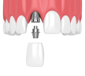 cleveland dental implants