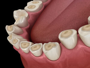 cleveland bruxism