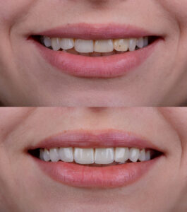 Cleveland, TX, dentist offers porcelain veneers 